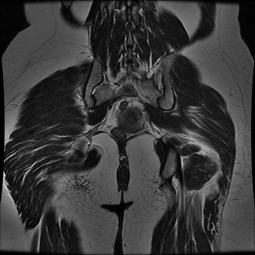 File:Abdominal wall endometriosis (Radiopaedia 83702-98847 Coronal T2 15).jpg