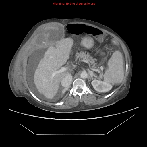 File:Abdominal wall hematoma (Radiopaedia 9427-10112 Axial C+ portal venous phase 33).jpg