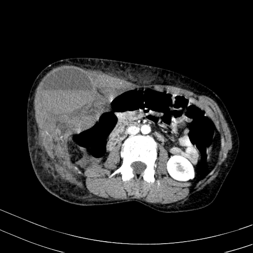 Abdominal wall hematoma with active bleeding (Radiopaedia 83915-99117 Axial renal cortical phase 40).jpg