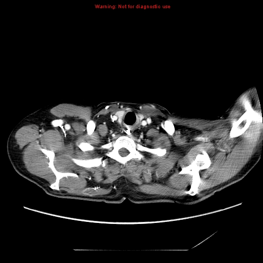 Aberrant right subclavian artery (Radiopaedia 9379-10071 Axial C+ arterial phase 4).jpg