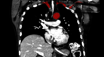 File:Aberrant right subclavian artery (Radiopaedia 9379-38993 Coronal 14).jpg