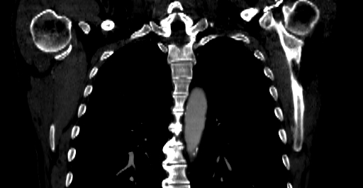 Accesory rib joint (Radiopaedia 71987-82452 Coronal bone window 24).jpg