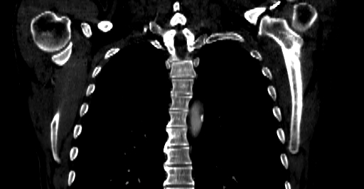 Accesory rib joint (Radiopaedia 71987-82452 Coronal bone window 31).jpg