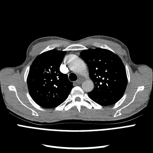 Accessory left horizontal fissure with lingular pneumonia (Radiopaedia 53763-59843 Axial C+ CTPA 31).jpg