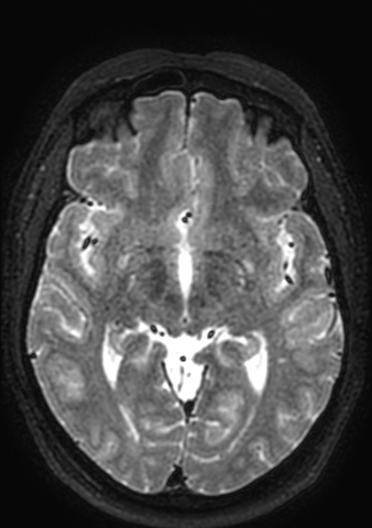 Accessory middle cerebral artery (Radiopaedia 73114-83828 Axial T2 91).jpg