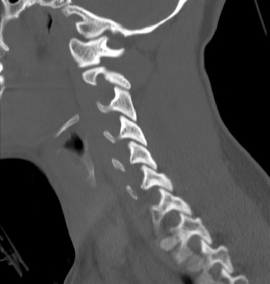 File:Accessory ossicle of the anterior arch of C1 vertebra (Radiopaedia 58149-65211 Sagittal bone window 15).jpg