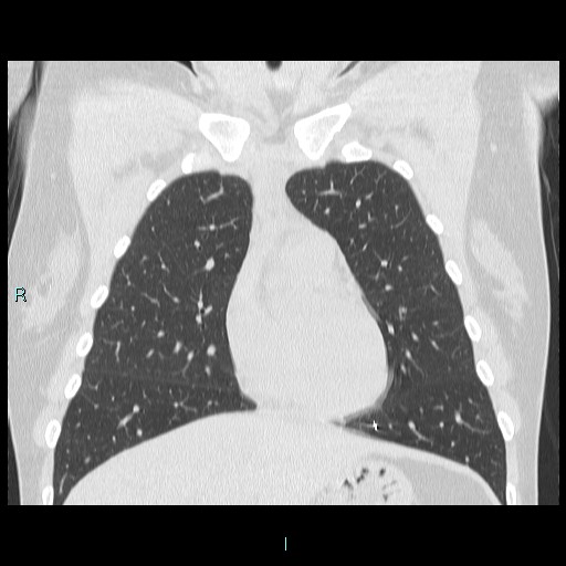 File:Accidental foreign body aspiration (seamstress needle) (Radiopaedia 77740-89983 Coronal lung window 43).jpg