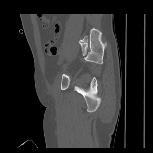 Acetabular and ilial fractures (Radiopaedia 59084-66378 Sagittal bone window 35).jpg