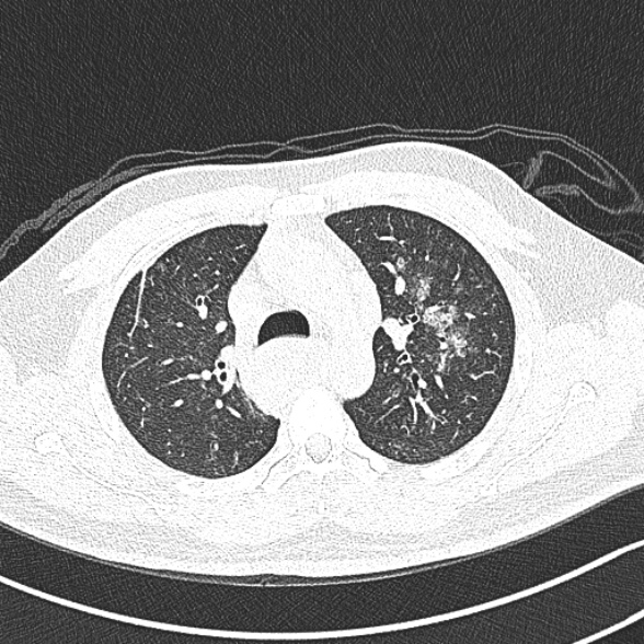 Achalasia with aspiration (Radiopaedia 55413-61845 Axial lung window 22).jpg