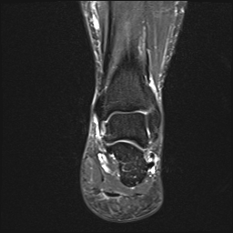 File:Achilles tendon tear (Radiopaedia 77615-89819 Coronal STIR 17).jpg