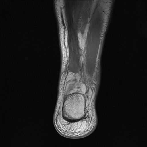File:Achilles tendon tear (Radiopaedia 77615-89819 Coronal T1 24).jpg