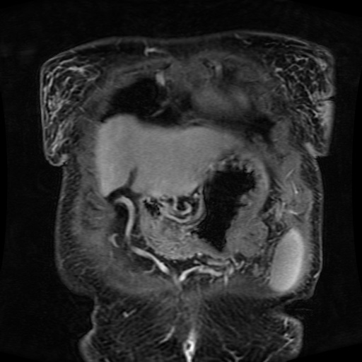 Acinar cell carcinoma of the pancreas (Radiopaedia 75442-86668 Coronal T1 C+ fat sat 159).jpg
