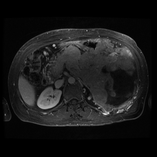 Acinar cell carcinoma of the pancreas (Radiopaedia 75442-86668 D 57).jpg