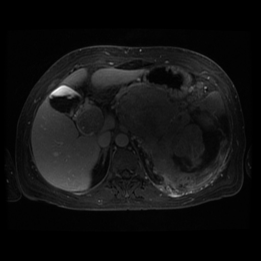 Acinar cell carcinoma of the pancreas (Radiopaedia 75442-86668 D 82).jpg