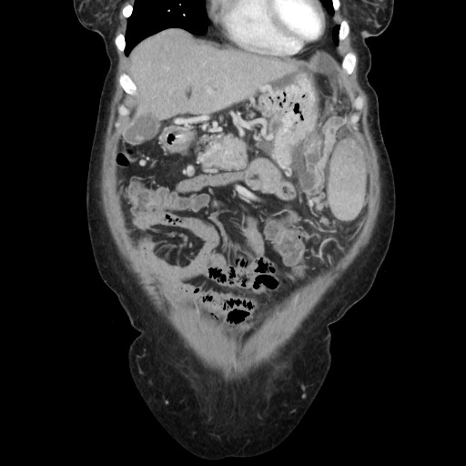 File:Acinar cell carcinoma of the pancreas (Radiopaedia 75442-86669 Coronal C+ portal venous phase 31).jpg