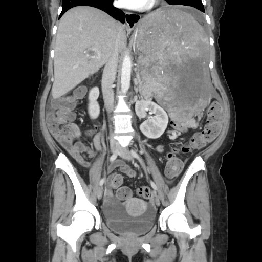 Acinar cell carcinoma of the pancreas (Radiopaedia 75442-86669 Coronal C+ portal venous phase 68).jpg