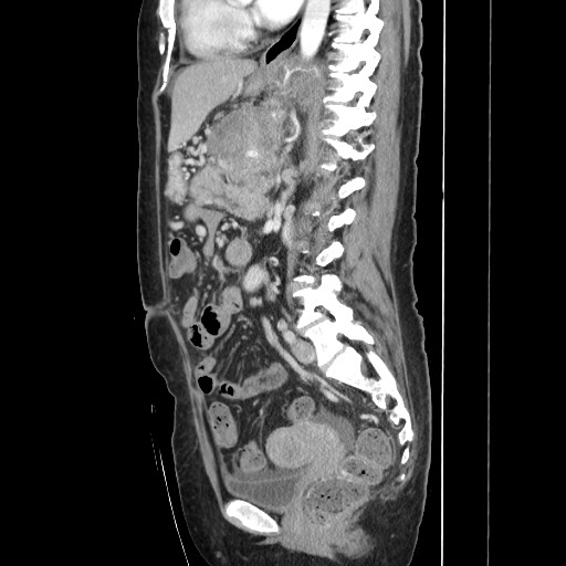 File:Acinar cell carcinoma of the pancreas (Radiopaedia 75442-86669 Sagittal C+ portal venous phase 107).jpg