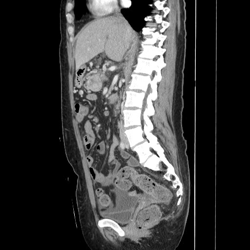 File:Acinar cell carcinoma of the pancreas (Radiopaedia 75442-86669 Sagittal C+ portal venous phase 91).jpg