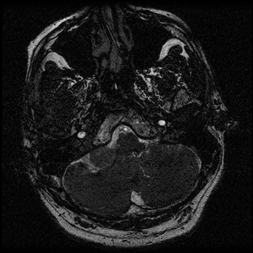 File:Acoustic schwannoma (Radiopaedia 39170-41387 Axial FIESTA 38).png