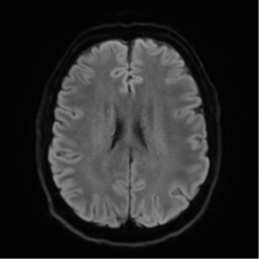 Acoustic schwannoma (Radiopaedia 50846-56358 Axial DWI 46).png