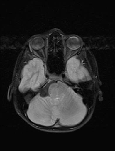 File:Acquired cerebellar tonsillar ectopia (Radiopaedia 39950-42423 Axial FLAIR 6).jpg