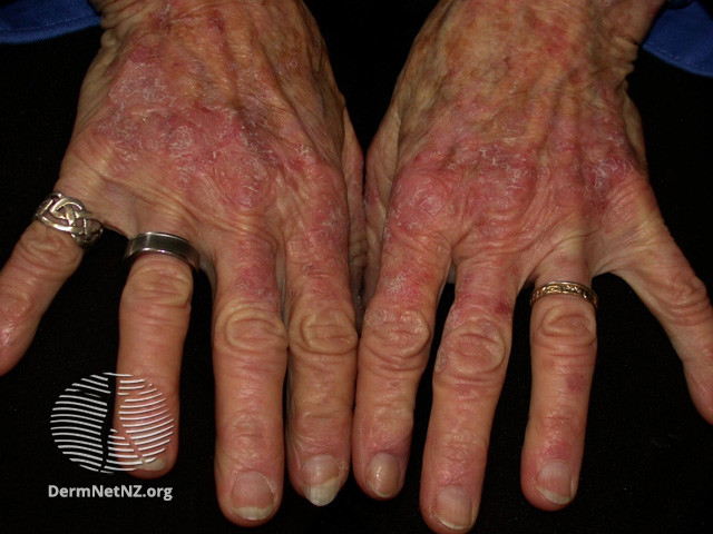 File:Actinic keratoses affecting the hands (DermNet NZ lesions-ak-hands-347).jpg