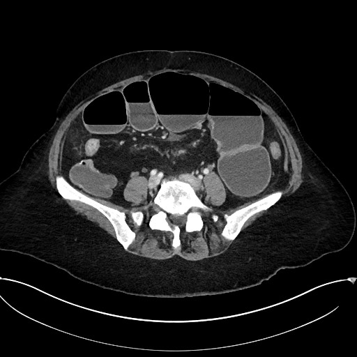 Active Crohn disease (Radiopaedia 59394-66750 Axial C+ portal venous phase 48).jpg