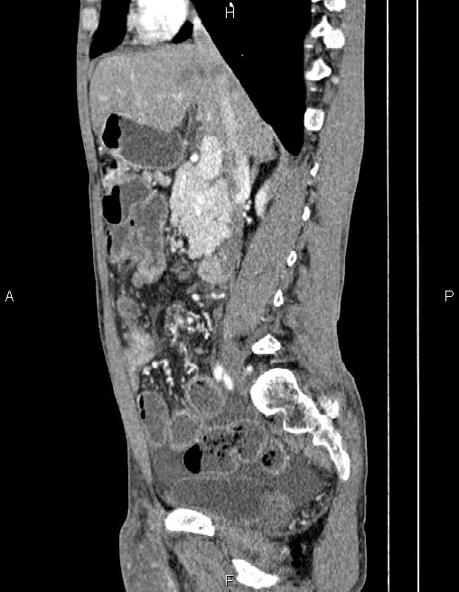 Active crohn disease (Radiopaedia 87133-103397 Sagittal C+ arterial phase 36).jpg