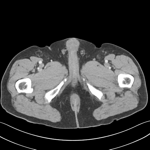 File:Active diverticular hemorrhage (Radiopaedia 39415-41725 Axial C+ portal venous phase 81).png