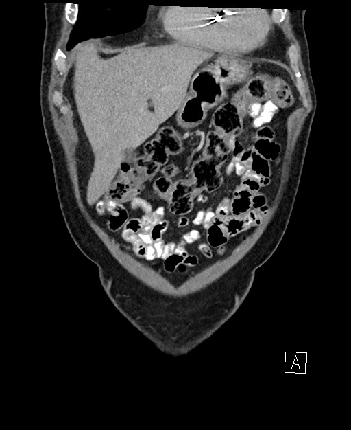 Active lower gastrointestinal bleeding - diverticular (Radiopaedia 61203-69106 Coronal C+ portal venous phase 29).jpg