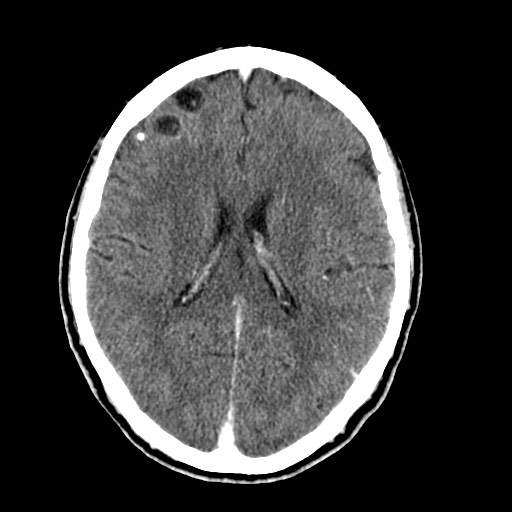 File:Active neurocysticercosis before and after therapy (Radiopaedia 71710-82099 Axial 21).jpg