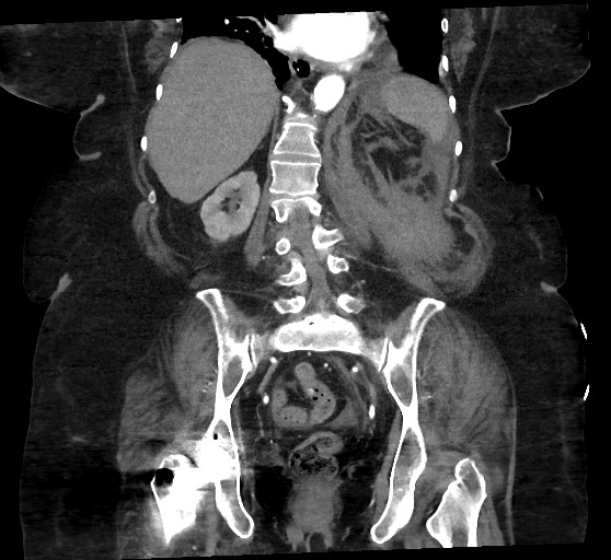 Active renal extravasation with large subcapsular and retroperitoneal hemorrhage (Radiopaedia 60975-68796 Coronal C+ arterial phase 104).jpg