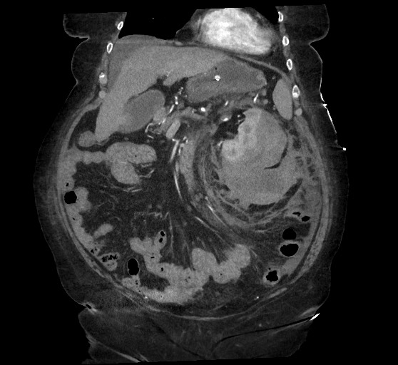 Active renal extravasation with large subcapsular and retroperitoneal hemorrhage (Radiopaedia 60975-68796 Coronal C+ arterial phase 56).jpg