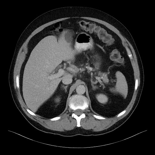 Acute-on-chronic pancreatitis (Radiopaedia 67286-76656 Axial C+ portal venous phase 22).jpg