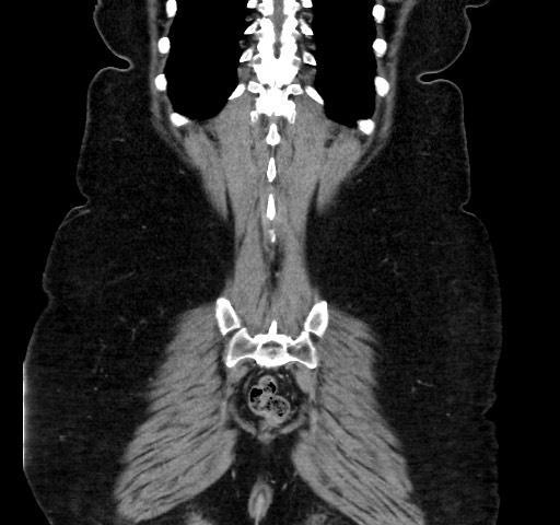 Acute appendicitis, heterotaxy syndrome (Radiopaedia 66884-76202 Coronal C+ portal venous phase 109).jpg