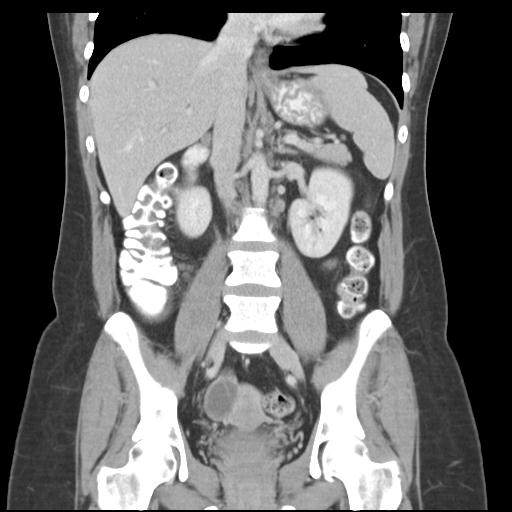 Acute appendicitis (Radiopaedia 30297-30934 Coronal C+ portal venous phase 26).jpg
