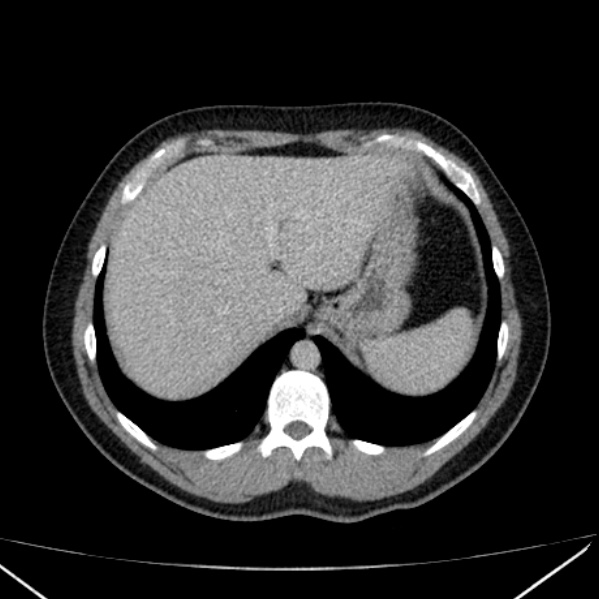 Acute appendicitis (Radiopaedia 38255-40270 Axial C+ portal venous phase 15).jpg