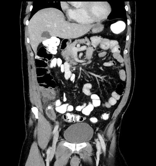 Acute appendicitis (Radiopaedia 77016-88960 Coronal C+ portal venous phase 41).jpg