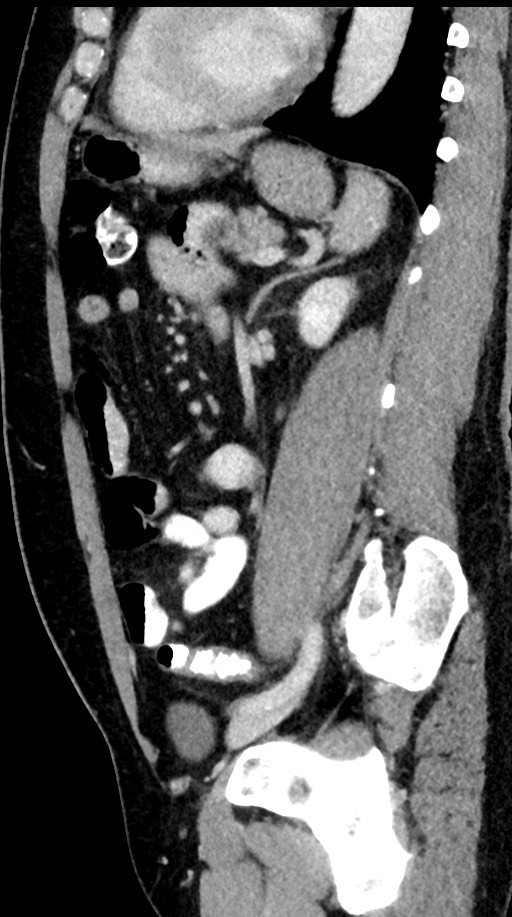 Acute appendicitis (Radiopaedia 77016-88960 Sagittal C+ portal venous phase 43).jpg