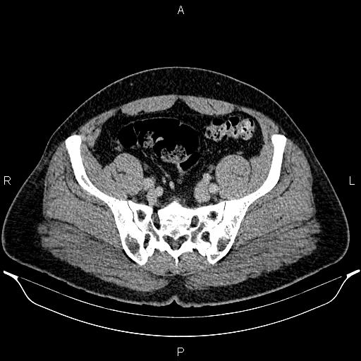 Acute appendicitis (Radiopaedia 84780-100240 Axial C+ portal venous phase 85).jpg