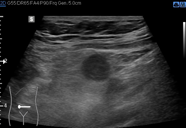 File:Acute appendicitis (Radiopaedia 85193-100745 D 144).jpg