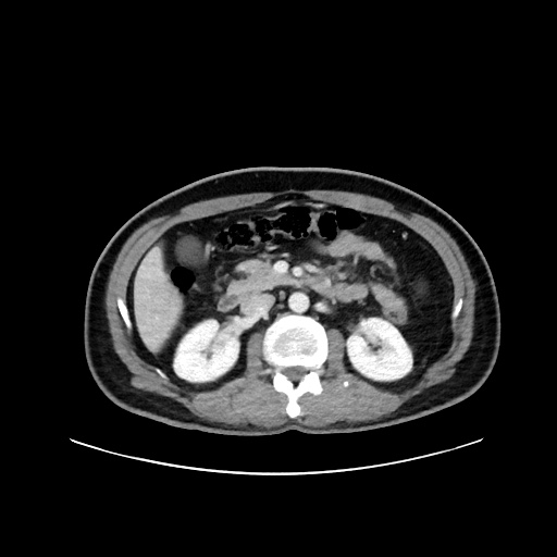File:Acute appendicitis and COVID 19 pneumonia (Radiopaedia 76604-88380 Axial C+ portal venous phase 32).jpg