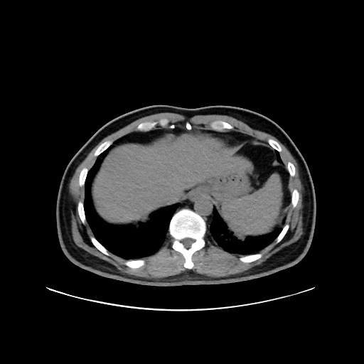 Acute appendicitis and COVID 19 pneumonia (Radiopaedia 76604-88380 Axial non-contrast 48).jpg