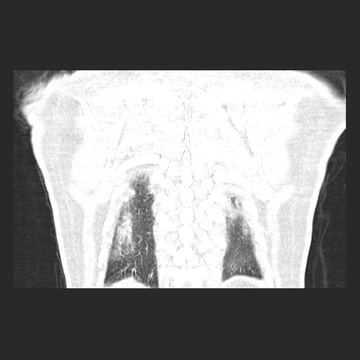 Acute appendicitis and COVID 19 pneumonia (Radiopaedia 76604-88380 G 57).jpg