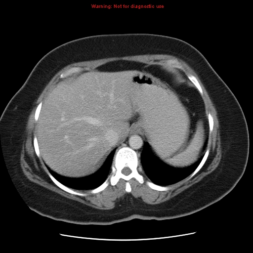 File:Acute appendicitis complicated by ovarian vein thrombophlebitis (Radiopaedia 16172-15851 Axial C+ portal venous phase 20).jpg