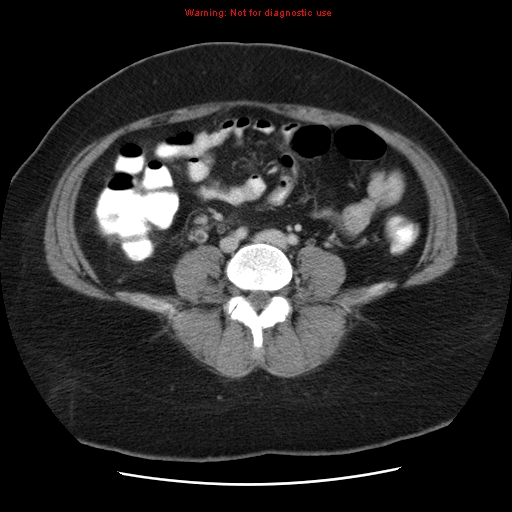 Acute appendicitis complicated by ovarian vein thrombophlebitis (Radiopaedia 16172-15851 Axial C+ portal venous phase 59).jpg