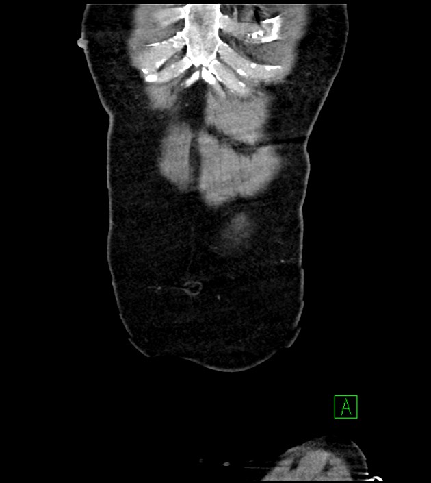 Acute arterial mesenteric ischemia (Radiopaedia 78238-90828 Coronal C+ portal venous phase 14).jpg