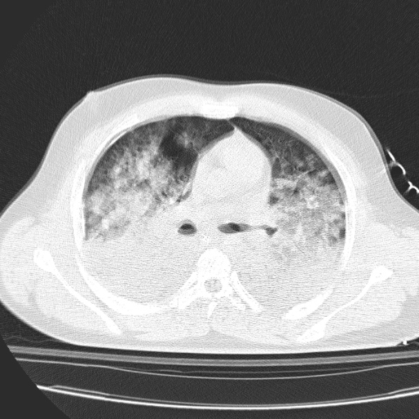 Acute aspiration pneumonitis (Radiopaedia 33605-34703 Axial lung window 45).jpg