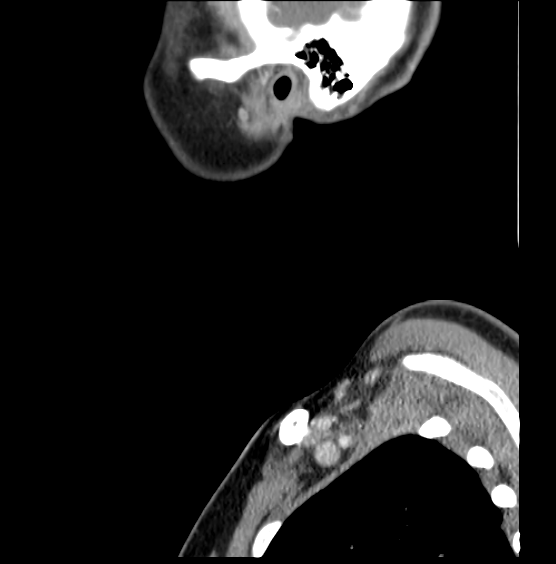 Acute bacterial tonsillitis (Radiopaedia 27573-27781 Sagittal C+ portal venous phase 62).png