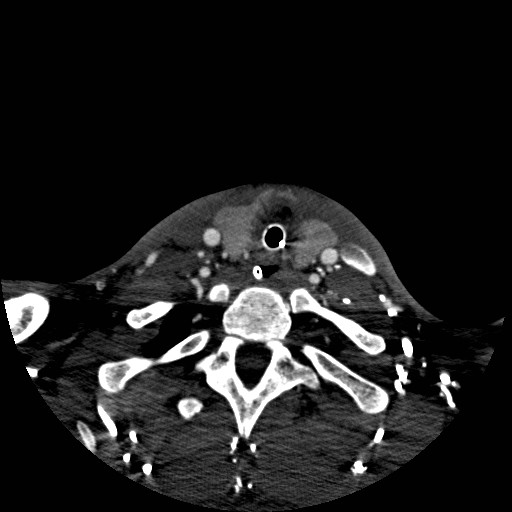 Acute basilar artery occlusion (Radiopaedia 43582-46985 Axial C+ arterial phase 271).jpg